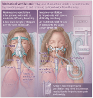 Endotracheal Tube In Ventilated Patients